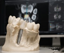 Implante dentário com planejamento digital